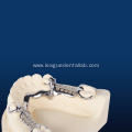Custom Metal Partial Denture